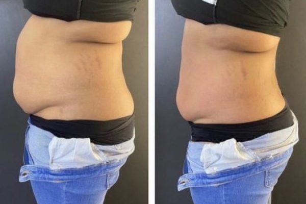 Lipocavitation